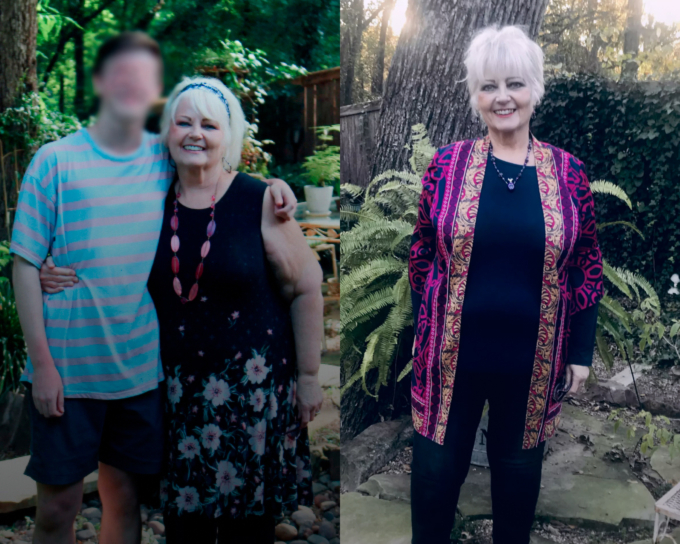before and after, medically assisted weight loss